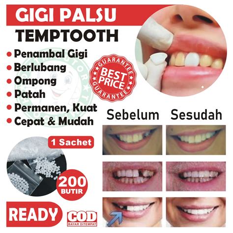 Cara melepas gigi palsu temptooth  Gigi palsu penuh atau lengkap menggantikan semua gigi yang hilang pada rahang atas atau bawah